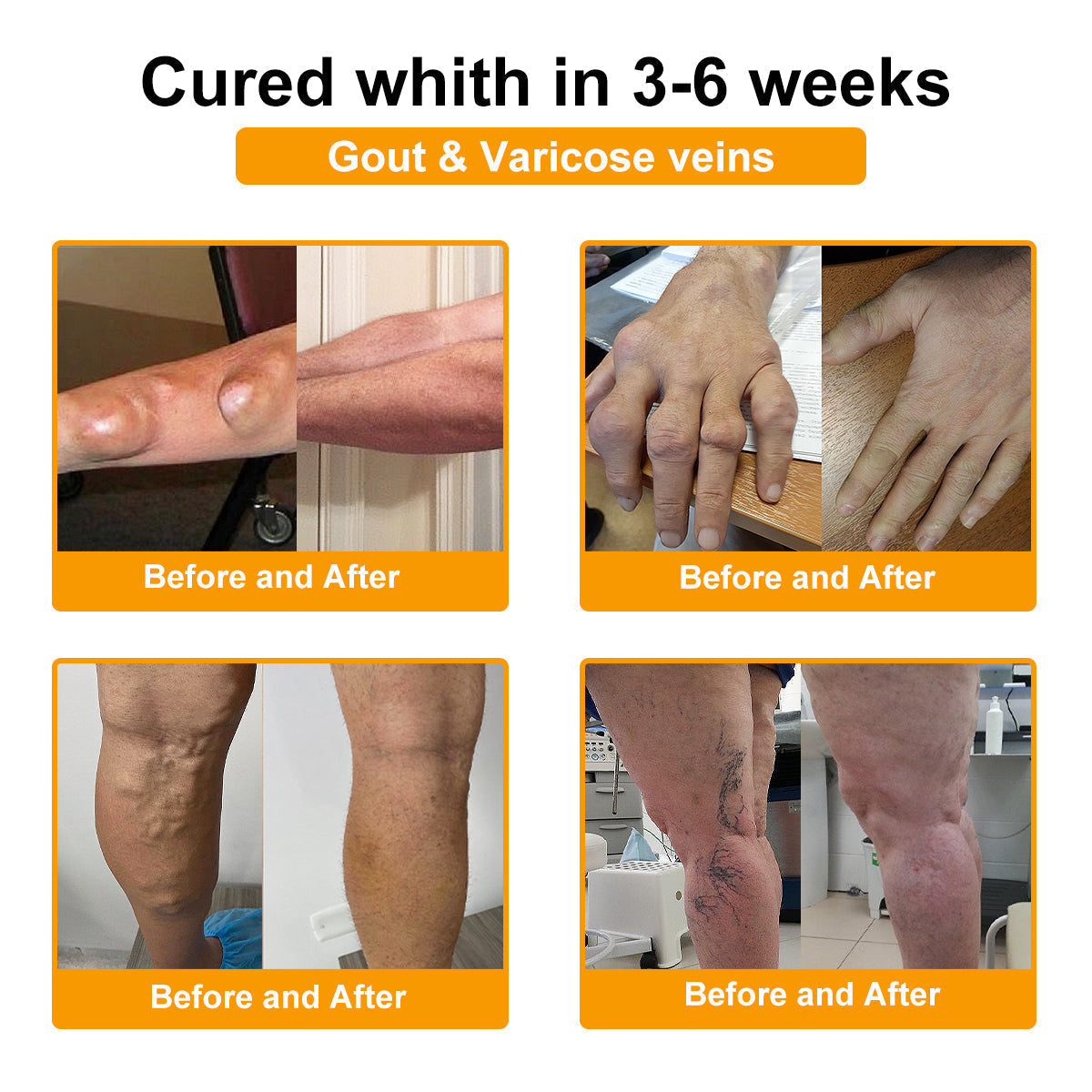 TLOPA® Botulinum Toxin és Méhméreg Fájdalomcsillapító Csontgyógyító Krém🐝🌿 (Kifejezetten időseknek & ortopéd szakorvosok ajánlásával)🔥🔥