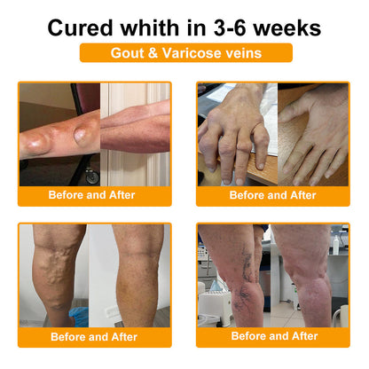 TLOPA® Botulinum Toxin és Méhméreg Fájdalomcsillapító Csontgyógyító Krém🐝🌿 (Kifejezetten időseknek & ortopéd szakorvosok ajánlásával)🔥🔥