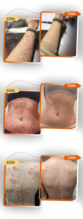 ✅ Zvoevo® Fekete Rizses Bőrregeneráló Krém 👨‍⚕️ (Szemölcsök, bőrkinövések, foltok és hiperpigmentáció kezelésére)🍀