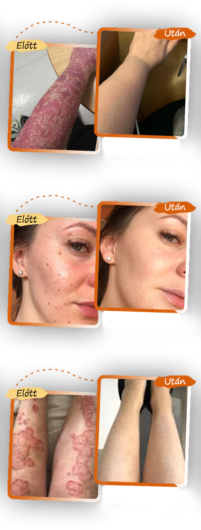 ✅ Zvoevo® Fekete Rizses Bőrregeneráló Krém 👨‍⚕️ (Szemölcsök, bőrkinövések, foltok és hiperpigmentáció kezelésére)🍀