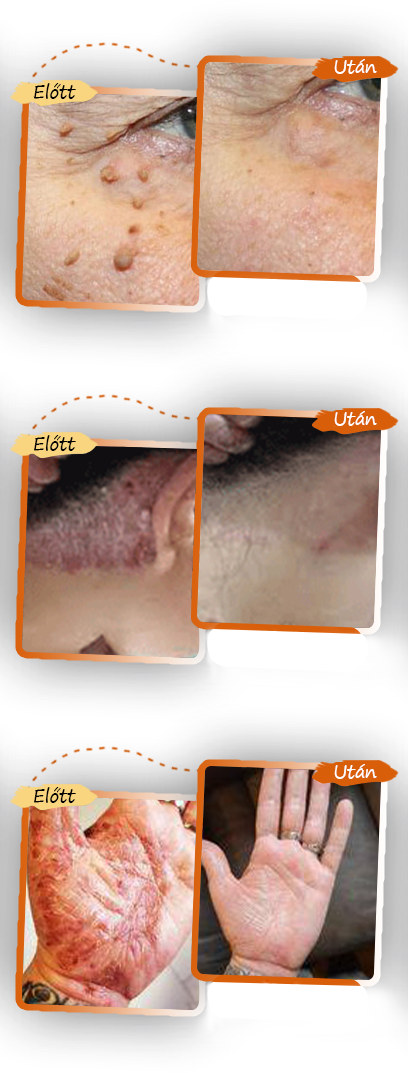 ✅ Zvoevo® Fekete Rizses Bőrregeneráló Krém 👨‍⚕️ (Szemölcsök, bőrkinövések, foltok és hiperpigmentáció kezelésére)🍀