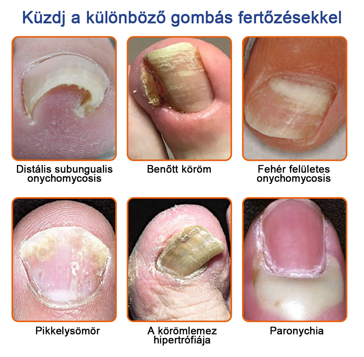 🐝Furzero™ Méhméreg Körömgomba Kezelőoldat: Teljes megoldás a körömgomba problémájára🌟👣👣