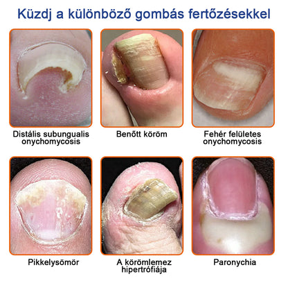 🐝Furzero™ Méhméreg Körömgomba Kezelőoldat: Teljes megoldás a körömgomba problémájára🌟👣👣