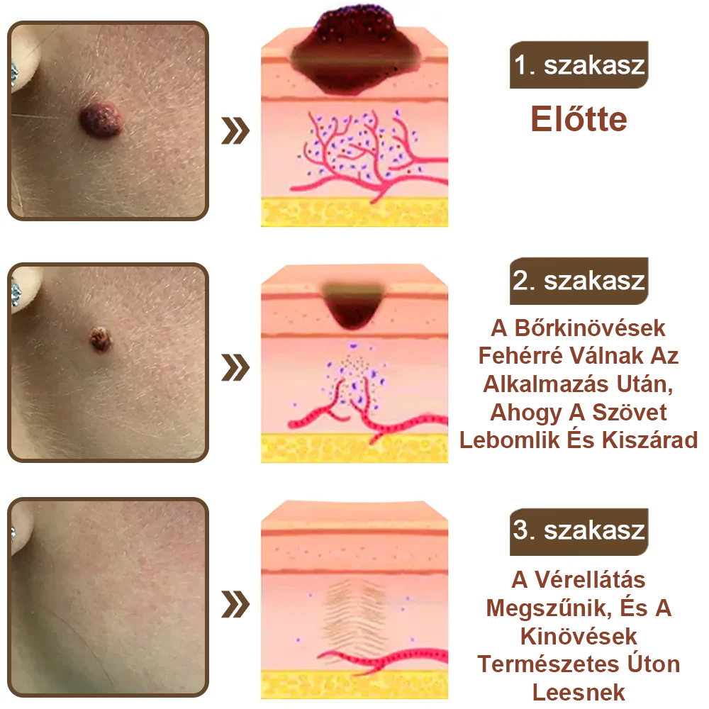 ✅ Zvoevo® Fekete Rizses Bőrregeneráló Krém 👨‍⚕️ (Szemölcsök, bőrkinövések, foltok és hiperpigmentáció kezelésére)🍀