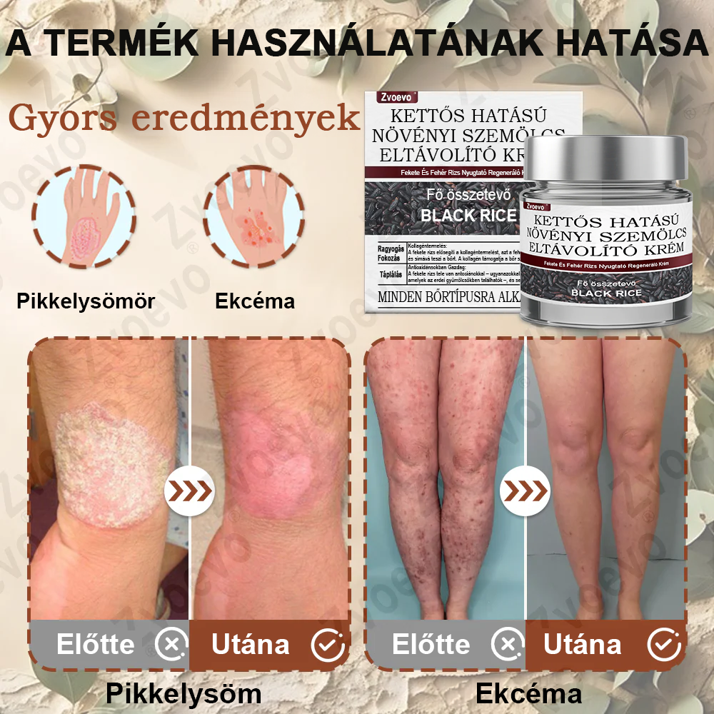 ✅ Zvoevo® Fekete Rizses Bőrregeneráló Krém 👨‍⚕️ (Szemölcsök, bőrkinövések, foltok és hiperpigmentáció kezelésére)🍀